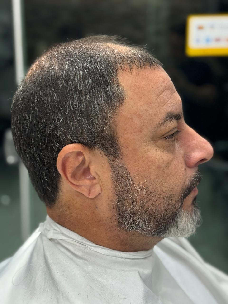 Antes da aplicação da prótese capilar